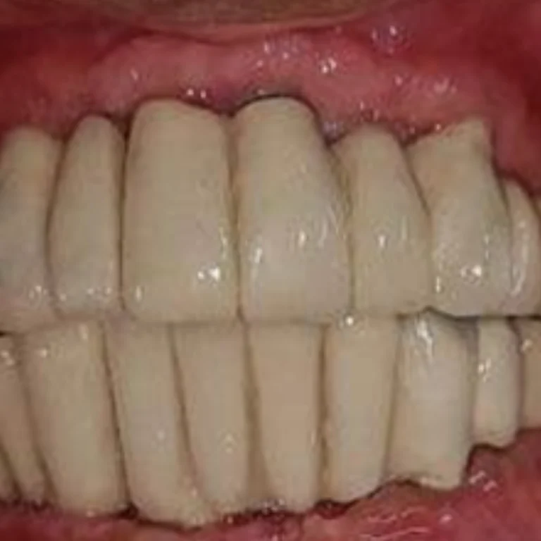 best dental implants treatment in eluru after photo