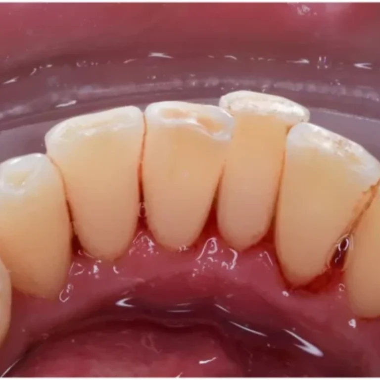 best dental scaling treatment in Eluru