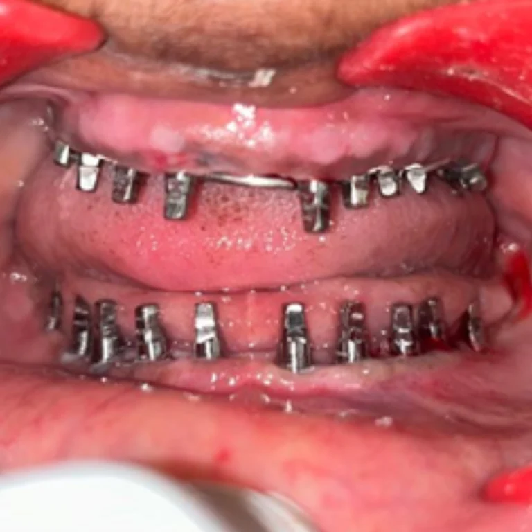 best dental implants treatment in Eluru Before photo