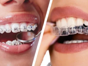 best aligners and braces services in eluru