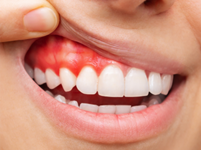 best gum treatment in Eluru at sitara dental clinic