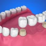 dental bridges in eluru at top dental clinic