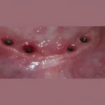 best over dentures in implant center