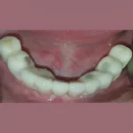 over dentures in eluru