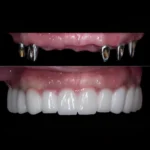 best full mouth dental implants in eluru