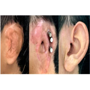 auricular treatment