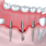 best basaloid implants in Eluru