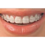 ceramic braces treatment Dental Clinic Near Me