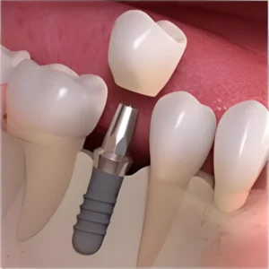 Best endosteal Implants in Eluru