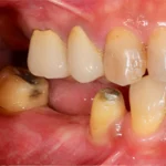 Best Dental implants in eluru