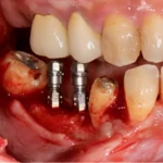 Dental implants in Eluru