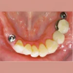 Best dental implants in eluru