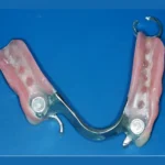 best rpd dental implants in eluru