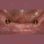 dental implants in eluru locator with abutments