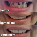 Immediate dentures by best dental clinic in eluru
