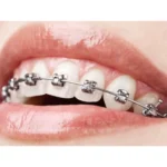 metal braces treatment in Eluru dental hospital near me