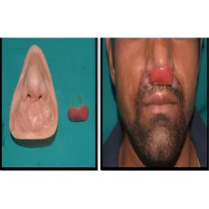 nasal stent treatment