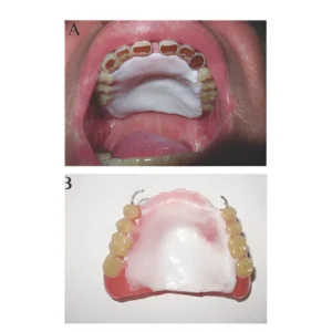 palatal augmentation treatment