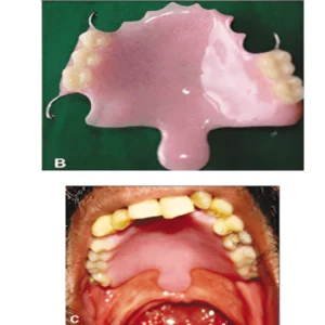 palatal lift treatment dentist