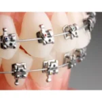 self-ligating braces treatment in eluru Dentist Near Me