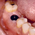 top single implant center