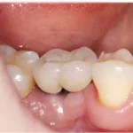 single implant center in eluru