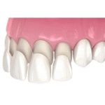 dental veneers at best dental clinic in eluru