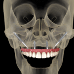 best zygomatic implants in Eluru