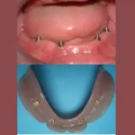 best dental in eluru bar and bar attachments