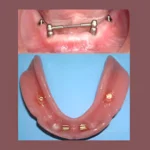 best implants in eluru bar and ball attachments